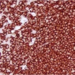 Tonsil: CD20 (m), ImmPRESS HRP Anti-Mouse IgG, Vector NovaRED Substrate.