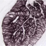 Colon Carcinoma: Pan-Cytokeratin (m), VECTASTAIN ABC-AP Kit, Vector Black (brown-black).