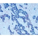 Tumor tissue section showing specific cytoplasmic cell staining (blue/gray, Vector SG) with Vector Nuclear Fast Red (red) counterstain.