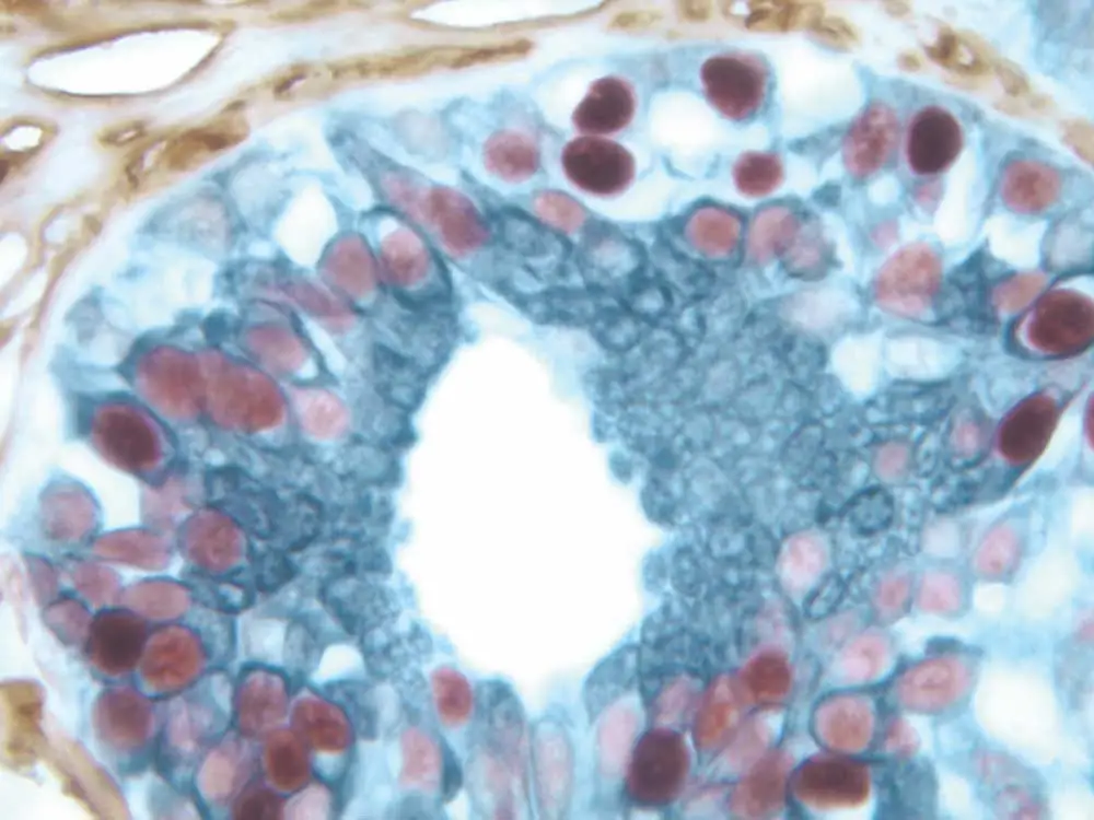 Breast Carcinoma 1 Breast Carcinoma 1