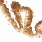 Paraffin embedded human prostate tissue stained using rabbit anti-prostate specific antigen (PSA) detected with VECTASTAIN Elite ABC Reagent and Vector DAB substrate.
