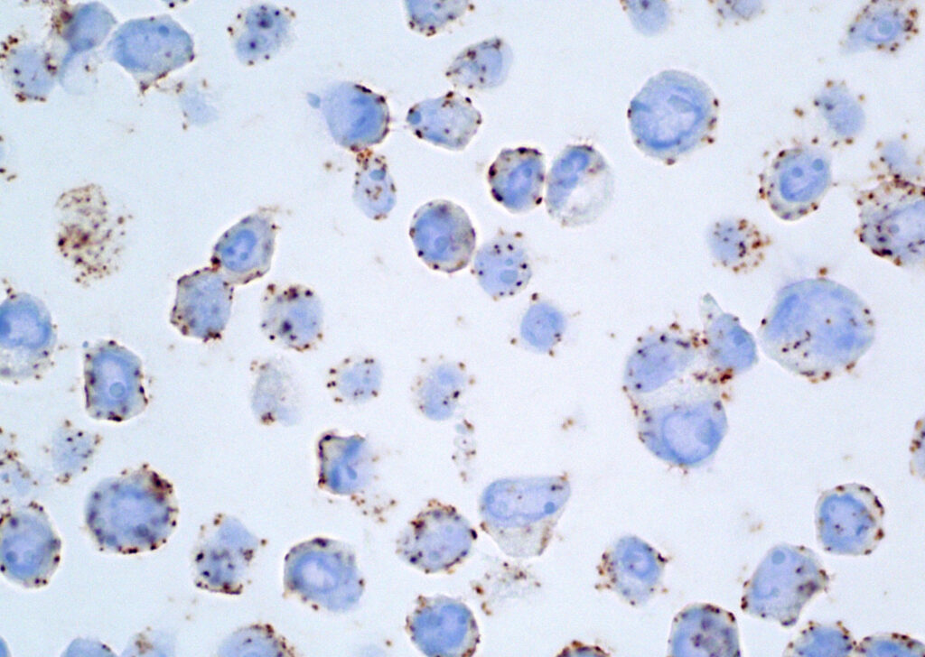 A New Focus for Breast Cancer: Protein Glycosylation's Emerging Role 2 BT474 Cell Pellet Edited