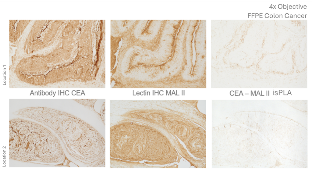 Revisiting Colon Cancer Metastasis Through a Glycobiology Lens 2 Colon Cancer CEA isPLA