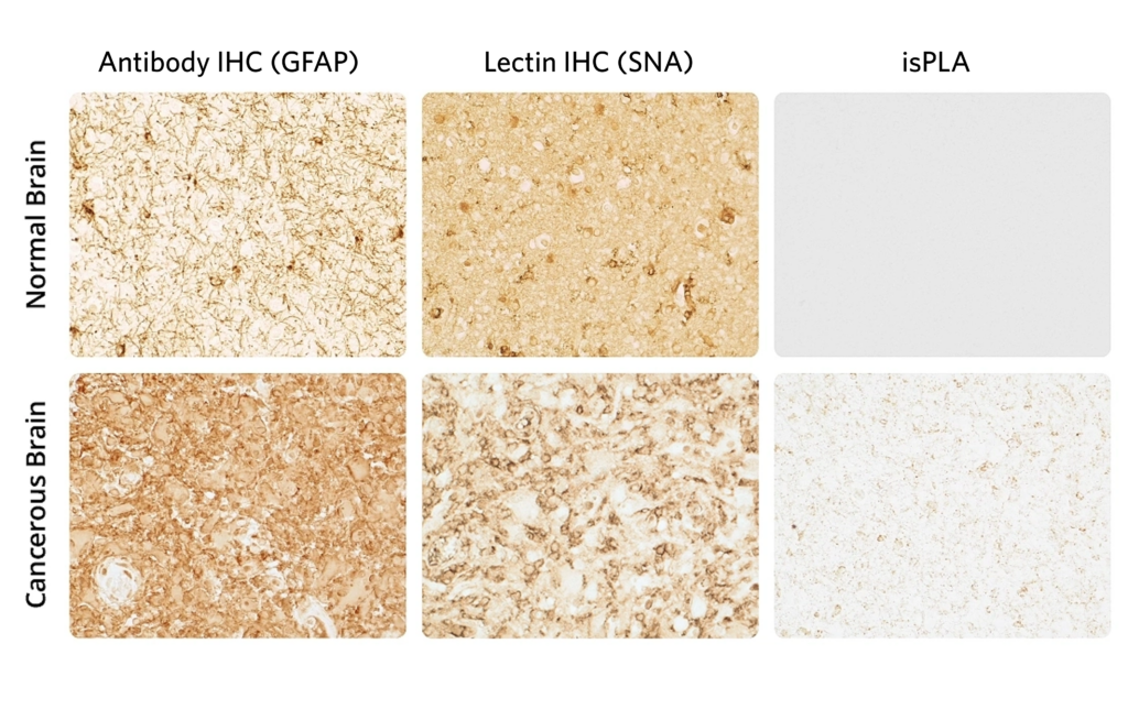 Glycosylation in the Alzheimer’s Brain: Visualizing New Paths to Diagnosis and Therapy 2 GEK 1000 GFAP SNA isPLA EM2