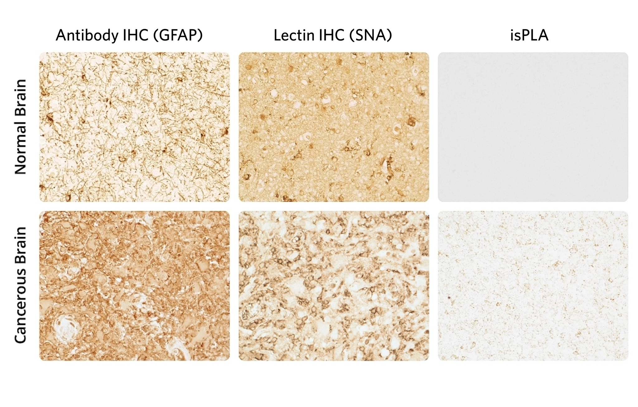 Glycosylation In The Alzheimer’s Brain: Visualizing New Paths To ...