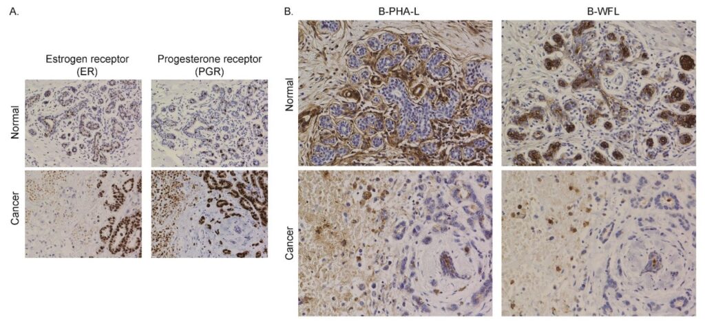 A New Focus for Breast Cancer: Protein Glycosylation's Emerging Role 3 Glysite Scout breast cancer figure
