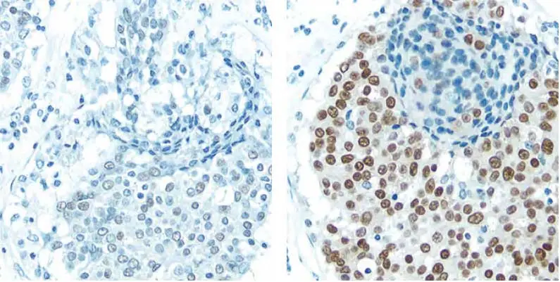 Breast Carcinoma blue brown Breast-Carcinoma-blue-brown Breast-Carcinoma-blue-brown