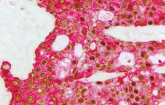 Breast Carcinoma red magenta