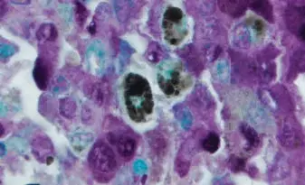 Melanoma methyl green counterstain Melanoma-methyl-green-counterstain Melanoma-methyl-green-counterstain