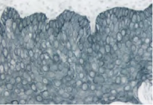 Tonsil Cytokeratin AE1 blue gray