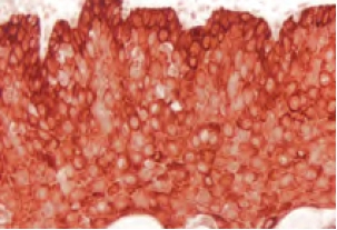 Tonsil Cytokeratin AE1 red