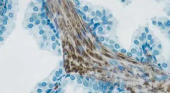 Tumor tissue counterstain blue