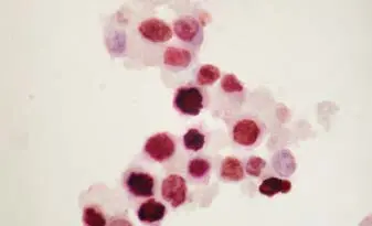 cytospin of ebv novared cytospin-of-ebv-novared cytospin-of-ebv-novared