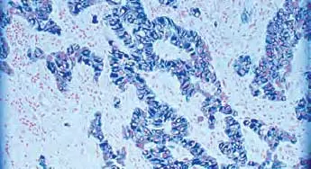 tumor counterstain red