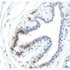 Breast Carcinoma: Progesterone Receptor (rm), ImmPRESS Universal Antibody Kit, DAB Substrate Kit (brown). Hematoxylin QS counterstain (blue).