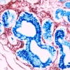 Breast Cancer (double Label): Epithelium (red, Vector NovaRED), endothelium (blue, Vector Blue).