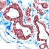 Breast Cancer (double label): Endothelium (red, Vector NovaRED), epithelium (blue, Vector Blue).
