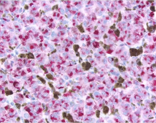 Melanoma stained with anti-melanoma marker (HMB45; mouse monoclonal, VP-M647), ImmPRESS™ AP Anti-Mouse Ig Reagent (MP-5402), and ImmPACT™ Vector® Red Alkaline Phosphatase Substrate (SK-5105).