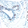 Breast Cancer: Estrogen receptor stained using VECTASTAIN Elite ABC Kit and Vector DAB (brown) substrate. Hematoxylin QS (blue) counterstain.