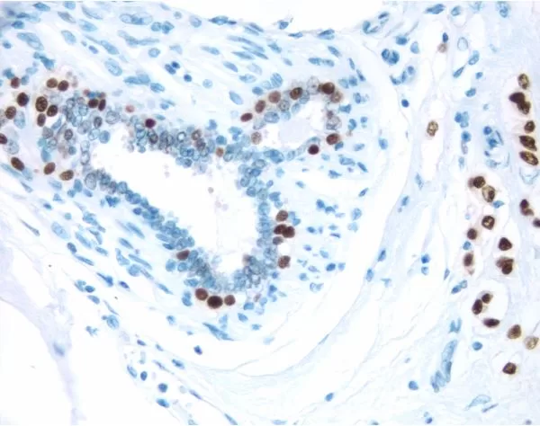 Breast Cancer: Estrogen receptor stained using VECTASTAIN Elite ABC Kit and Vector DAB (brown) substrate. Hematoxylin QS (blue) counterstain.