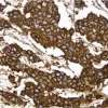 Breast Cancer: c-erbB2 oncoprotein stained using VECTASTAIN Elite ABC Kit and Vector DAB (brown) substrate. Hematoxylin QS (blue) counterstain.