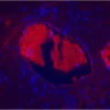 Prostate: Prostate Specific Antigen (rp) labeled with fluorescein using the ProtOn Fluorescein Labeling Kit. Fluorescein label detected with Alkaline Phosphatase Anti-Fluorescein and visualized with Vector Red. Mounted in VECTASHIELD HardSet Mounting
