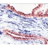 Tumor (double label): Cytokeratin, VECTASTAIN Elite ABC Kit, Vector NovaRED (red) substrate. CD34, VECTASTAIN ABC-AP Kit, BCIP/NBT (blue) substrate.