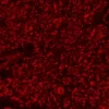 Melanoma Was Stained with Anti vimentin Followed by Immpress™ ap Anti rabbit Igg Reagent and Vector Red Substrate Viewed Under Fluorescence Microscopy Melanoma Was Stained with Anti vimentin Followed by Immpress™ ap Anti rabbit Igg Reagent and Vector Red Substrate Viewed Under Fluorescence Microscopy