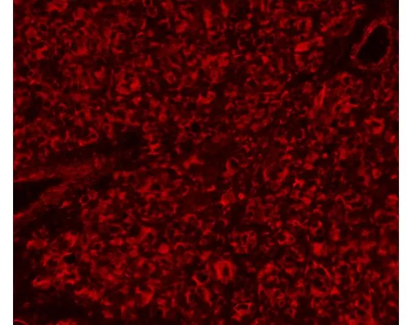 Melanoma was stained with anti-vimentin followed by ImmPRESS™-AP Anti-Rabbit IgG Reagent and Vector Red Substrate. Viewed under fluorescence microscopy.