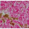 Melanoma was stained with anti-vimentin followed by ImmPRESS™-AP Anti-Rabbit IgG Reagent and Vector Red Substrate. Note the excellent contrast of the substrate with the brown pigments.