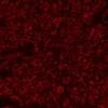 Melanoma: Anti-Vimentin (rabbit mab), ImmPRESS-AP Anti-Rabbit IgG, ImmPACT Vector Red Substrate (red).