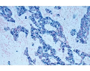 Tumor Tissue Section Showing Specific Cytoplasmic Cell Staining bluegray Vector Sg with Vector Nuclear Fast Red red Counterstain Tumor Tissue Section Showing Specific Cytoplasmic Cell Staining bluegray Vector Sg with Vector Nuclear Fast Red red Counterstain