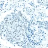 Breast Carcinoma: Without Citrate-based Antigen Unmasking Solution, Estrogen receptor (rm), ImmPRESS Anti-Rabbit Ig Kit, DAB (brown) substrate. Hematoxylin QS (blue) counterstain.