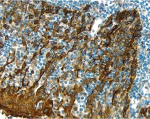 Tonsil: Cytokeratin (m), ImmPRESS Anti-Mouse Ig Kit, ImmPACT DAB (brown) substrate. Hematoxylin (blue) counterstain. Tonsil:  Cytokeratin (m), ImmPRESS Anti-Mouse Ig Kit, ImmPACT DAB (brown) substrate.  Hematoxylin (blue) counterstain.