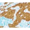 Tumor: Cytokeratin 18 (sheep), VECTASTAIN Elite ABC Kit for Sheep IgG, Vector DAB (brown), Vector Methyl Green counterstain (green).