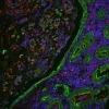 FFPE human colon carcinoma stained with Glysite Scout Glycan Screening Kit, Immunofluorescence 594 (GSK-2000, red), with colocalization of the pan-cytokeratin antibody AE1/AE3 (green). Nuclear detail was visualized by DAPI staining (blue).