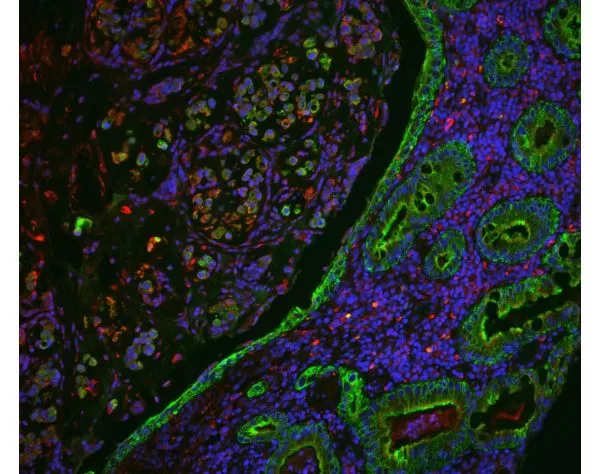 FFPE human colon carcinoma stained with Glysite Scout Glycan Screening Kit, Immunofluorescence 594 (GSK-2000, red), with colocalization of the pan-cytokeratin antibody AE1/AE3 (green). Nuclear detail was visualized by DAPI staining (blue).