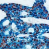 Breast Carcinoma (double label): Estrogen Receptor (m), ImmPRESS Universal Reagent, Vector NovaRED substrate (red); Cytokeratin 8/18 (m), VECTASTAIN Universal ABC-AP Kit, Vector Blue substrate (blue).