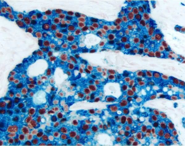 Breast Carcinoma (double label): Estrogen Receptor (m), ImmPRESS Universal Reagent, Vector NovaRED substrate (red); Cytokeratin 8/18 (m), VECTASTAIN Universal ABC-AP Kit, Vector Blue substrate (blue).