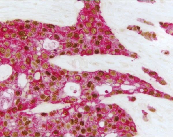 Breast Carcinoma (double label): Estrogen Receptor (m), ImmPRESS Universal Reagent, Vector DAB substrate (brown); Multi-Cytokeratin (m), VECTASTAIN Universal ABC-AP Kit, Vector Red substrate (red).
