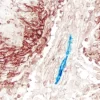 Mesothelioma (double label): M2A Antigen (m), VECTASTAIN Universal Elite ABC Kit, Vector NovaRED substrate (red); CD34 (m), VECTASTAIN Universal ABC-AP Kit, Vector Blue substrate (blue).