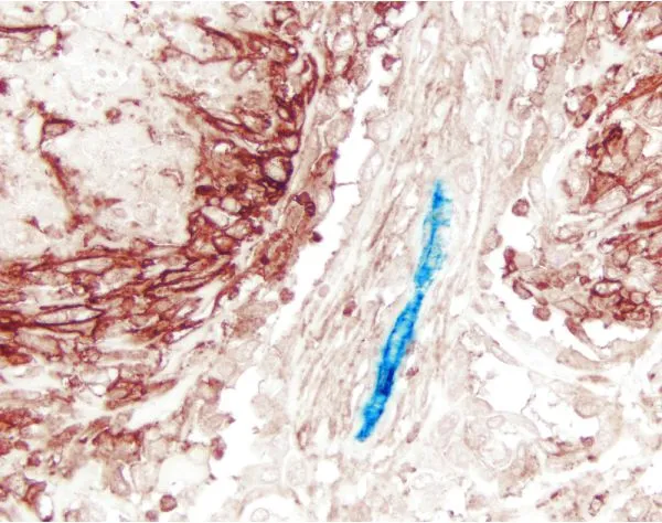 Mesothelioma (double label): M2A Antigen (m), VECTASTAIN Universal Elite ABC Kit, Vector NovaRED substrate (red); CD34 (m), VECTASTAIN Universal ABC-AP Kit, Vector Blue substrate (blue).