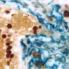 Breast Carcinoma (triple label): Estrogen Receptor (m), VECTASTAIN Elite ABC Kit, Vector NovaRED substrate (red); CD34 (m), VECTASTAIN ABC-AP Kit, Vector Blue substrate (blue); Cytokeratin 8/18 (m), VECTASTAIN Elite ABC Kit, DAB substrate (brown).