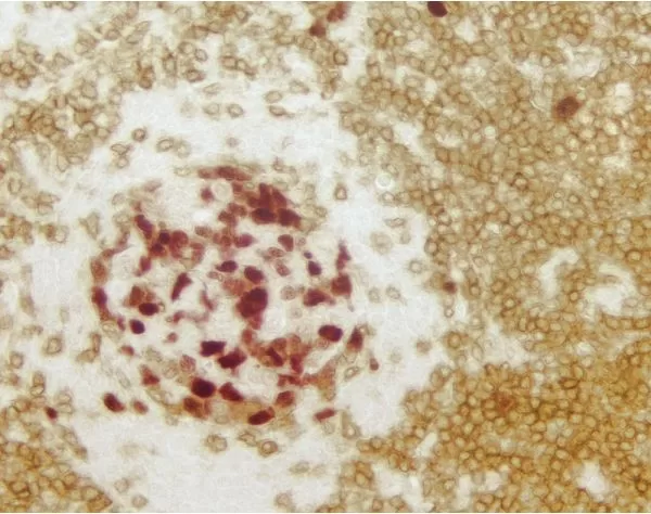 Tonsil (double label): Cyclin A (m), VECTASTAIN Universal ABC-AP Kit, Vector Red substrate (red); CD3 (m), VECTASTAIN Universal Elite ABC Kit, Vector DAB substrate (brown).