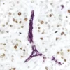 Breast Carcinoma (double label): Ki67 (rm), ImmPRESS Universal Reagent, DAB substrate (brown); CD34 (m), ImmPRESS Universal Reagent, Vector VIP substrate (purple). Breast Carcinoma (double label):  Ki67 (rm), ImmPRESS Universal Reagent, DAB substrate (brown); CD34 (m), ImmPRESS Universal Reagent, Vector VIP substrate (purple).
