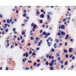 Tumor (double label): p53 (m), VECTASTAIN ABC-AP Kit, Vector Blue substrate (blue); Multi-Cytokeratin (m), VECTASTAIN Elite ABC Kit, AEC substrate (red).