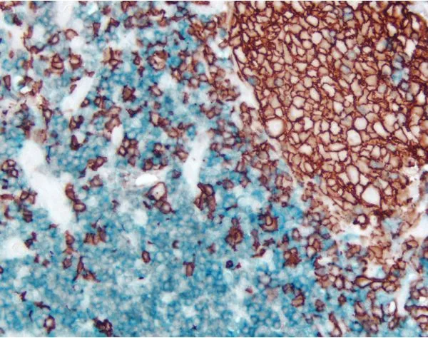 Tonsil (double label): CD3 (m), VECTASTAIN Universal ABC-AP Kit, Vector Blue substrate (blue); CD20 (m), ImmPRESS Universal Reagent, Vector NovaRED substrate (red).