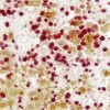 Lymph Node (double label): Ki67 (m), VECTASTAIN Universal ABC-AP Kit, Vector Red Substrate (red); Multi-cytokeratin (m), VECTASTAIN Universal Elite ABC Kit, DAB substrate (brown).