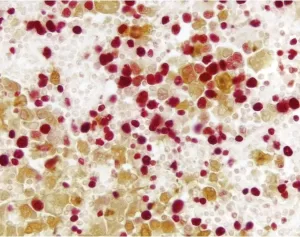 Lymph Node (double label): Ki67 (m), VECTASTAIN Universal ABC-AP Kit, Vector Red Substrate (red); Multi-cytokeratin (m), VECTASTAIN Universal Elite ABC Kit, DAB substrate (brown).