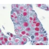 Tumor (double label): p53 protein (m), VECTASTAIN ABC-AP Kit, Vector Red substrate (red); Pan-Cytokeratin (m), VECTASTAIN Elite ABC Kit, Vector SG Substrate (blue/gray).